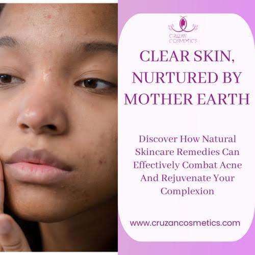 What is Acne, Causes of Acne and Acne Prevention Skincare Tips